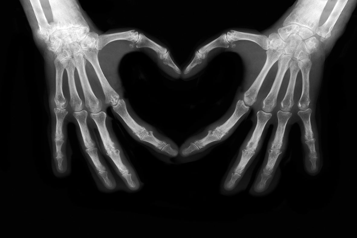 xray of bones in hand making shape of a heart