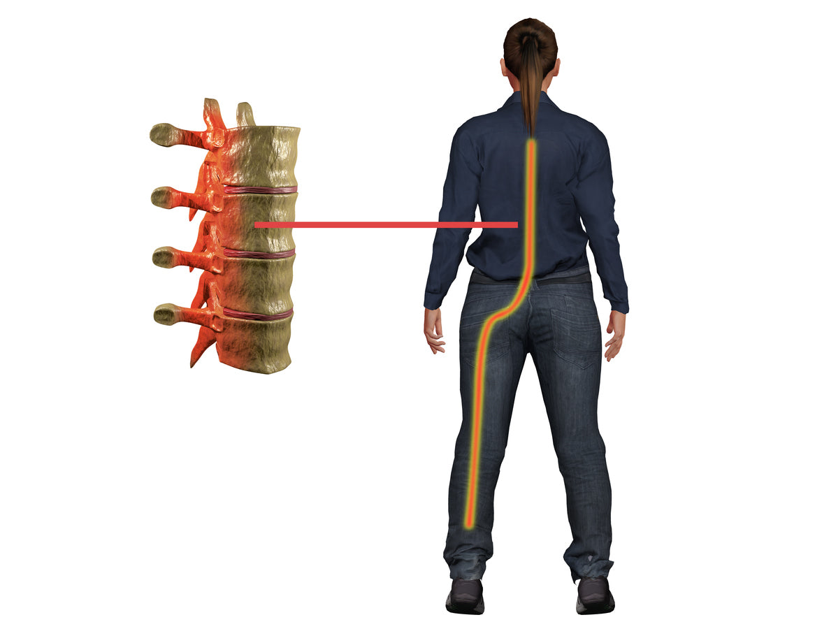 image of sciatica nerve location