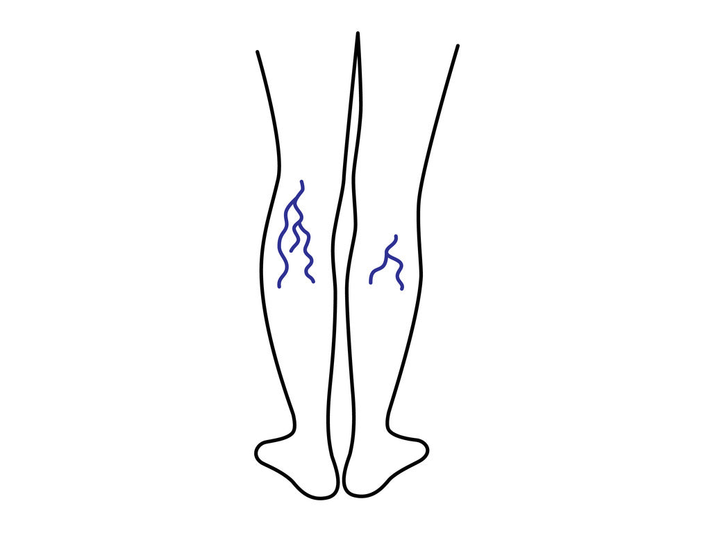 varicose veins in legs