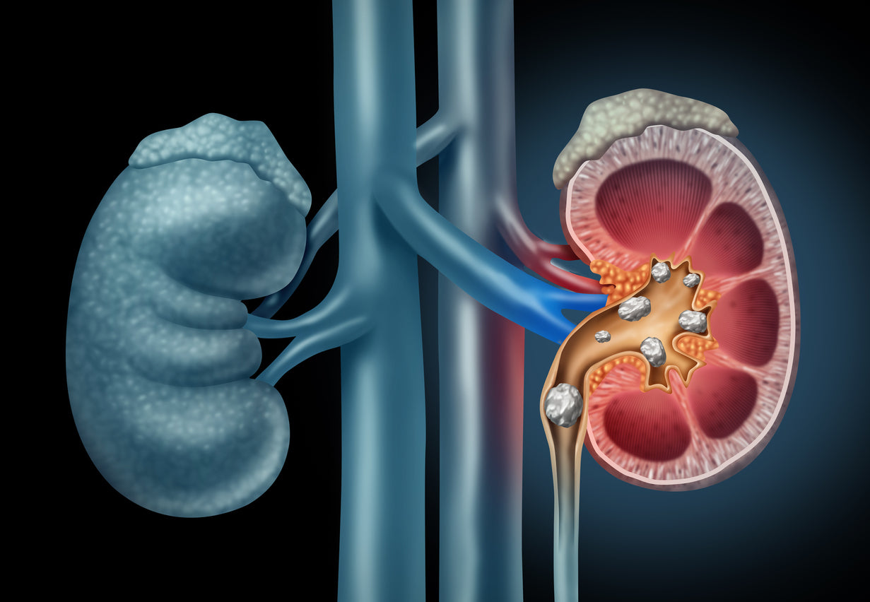 Kidney Stones: Symptoms and Treatment