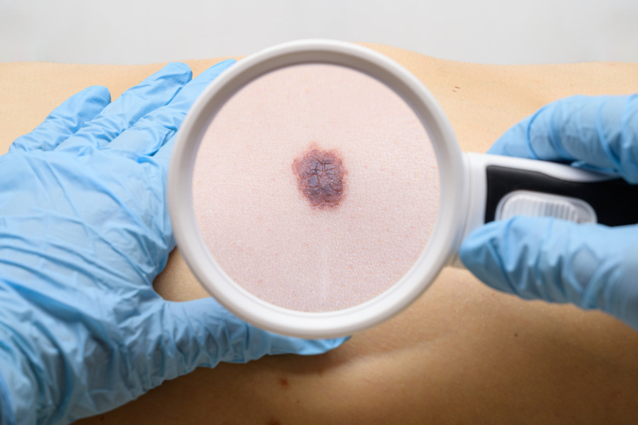 How Immunotherapy Is Changing the Prognosis of a Melanoma Diagnosis